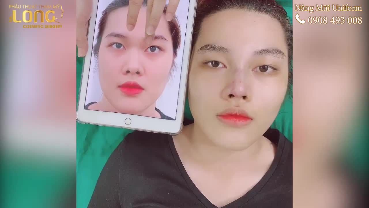 QUẢ MŨI CỰC ƯNG Ý CỦA KHÁCH HÀNG VỪA THỰC HIỆN XONG