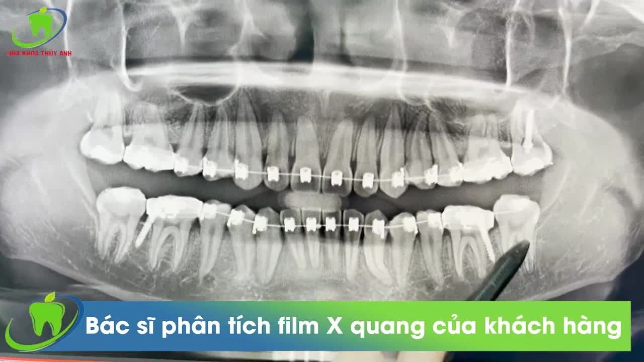 QUÁ TRÌNH CẮM MINIVIST ĐƯỢC DIỄN RA NHƯ THẾ NÀO
