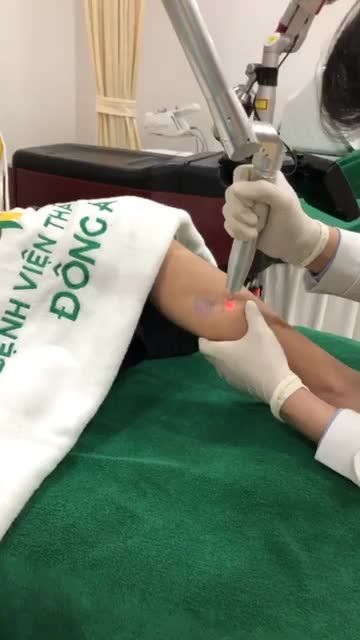 Quá trình xoá hình xăm tại bệnh viện thẫm Mỹ đông Á