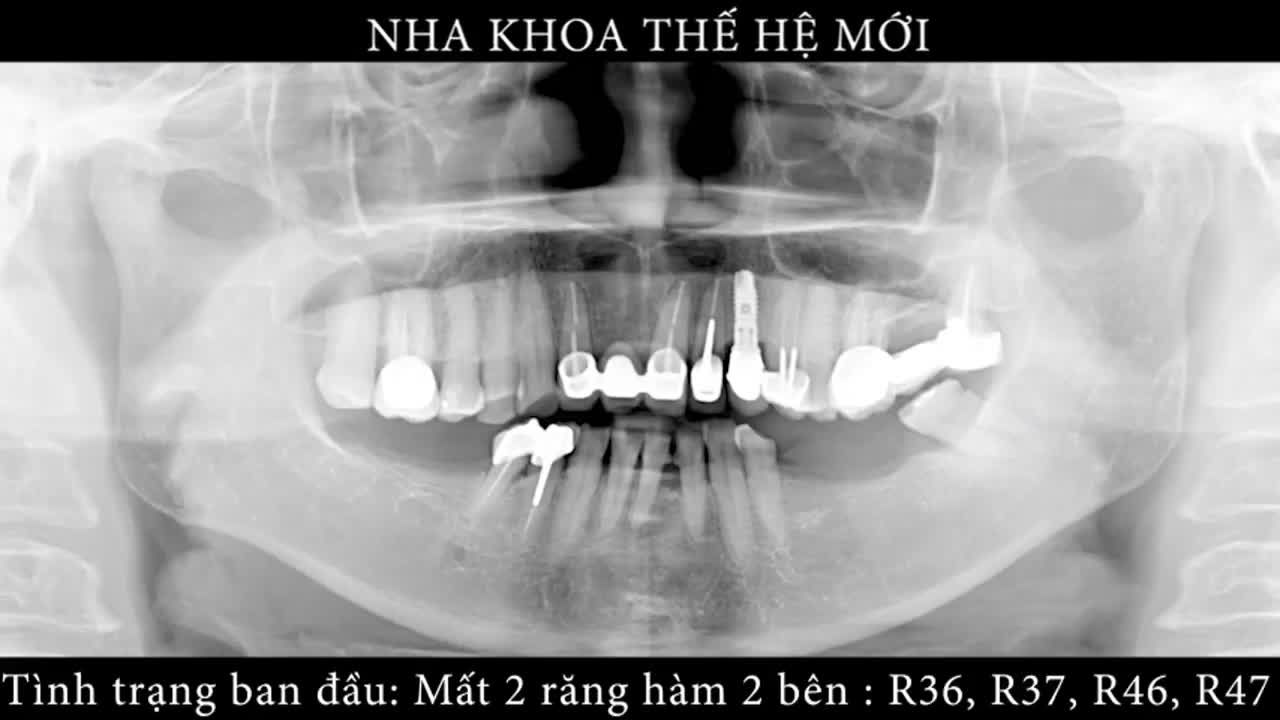 QUY TRÌNH CẤY GHÉP IMPLANT DIỄN RA THẾ NÀO