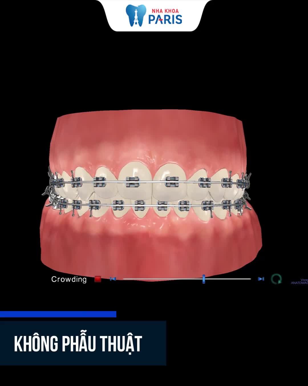QUY TRÌNH NIỀNG RĂNG 3D SPEED