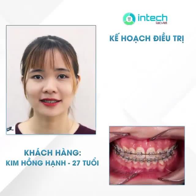 RĂNG KHẤP KHỂNH, CẮN CHÌA RĂNG CỬA THAY ĐỔI NHƯ THẾ NÀO KHI NIỀNG RĂNG