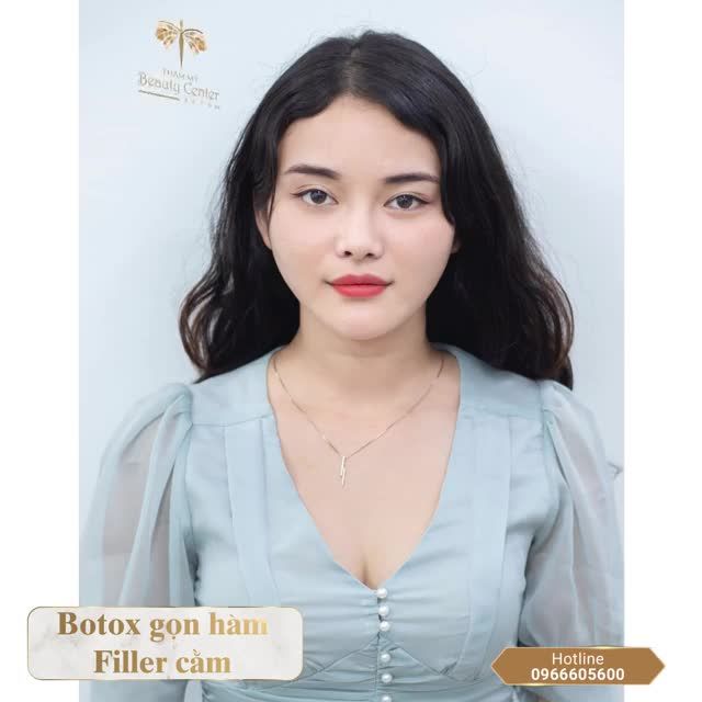 RẠNG RỠ TƯƠI XINH VỚI : Botox thon gọn hàm- Filler Cằm