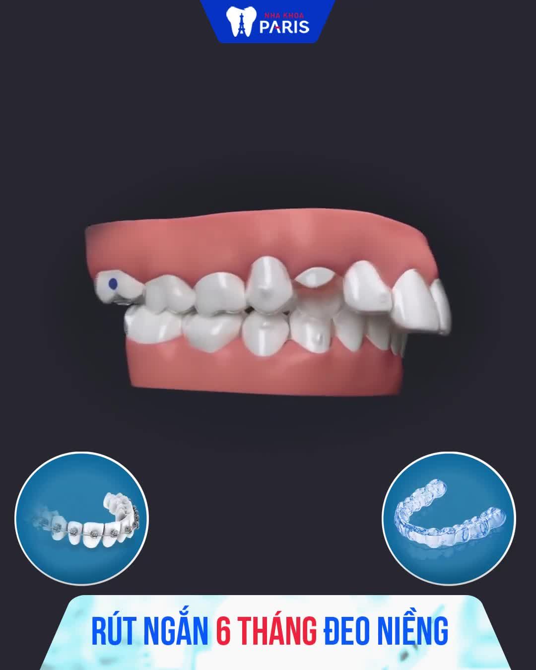 Răng xấu tệ phải làm sao? Click xem ngay giải pháp TỐT nhất hiện nay!