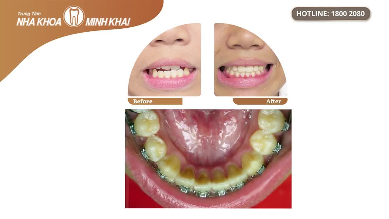 Sau khi cân nhắc các phương án điều trị, gia đình quyết định thực hiện niềng răng mắc cài kim loại.