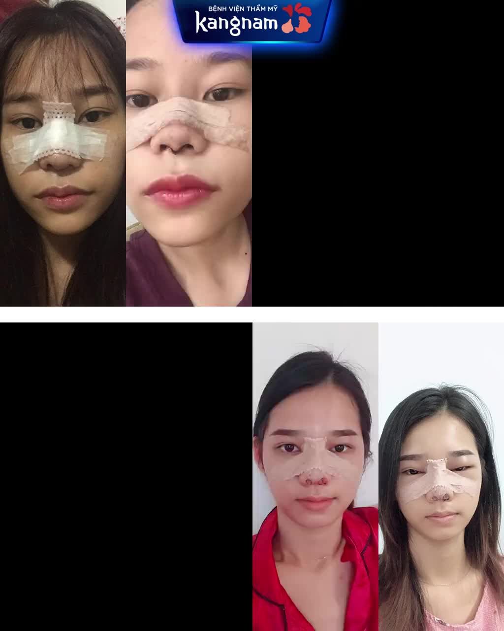 Siêu HOT! Nhập hội HOTGIRL hệ NÂNG MŨI