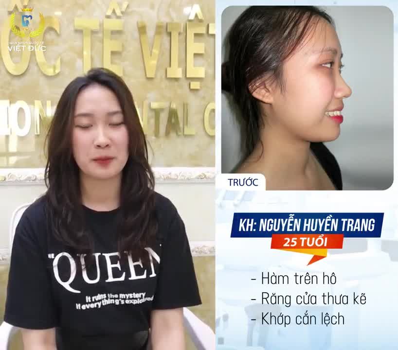 Sở hữu gương mặt xinh, cuốn hút nhưng Bạn Nguyễn Huyền Trang 25 tuổi - khách hàng của Nha khoa Quốc tế Việt Đức