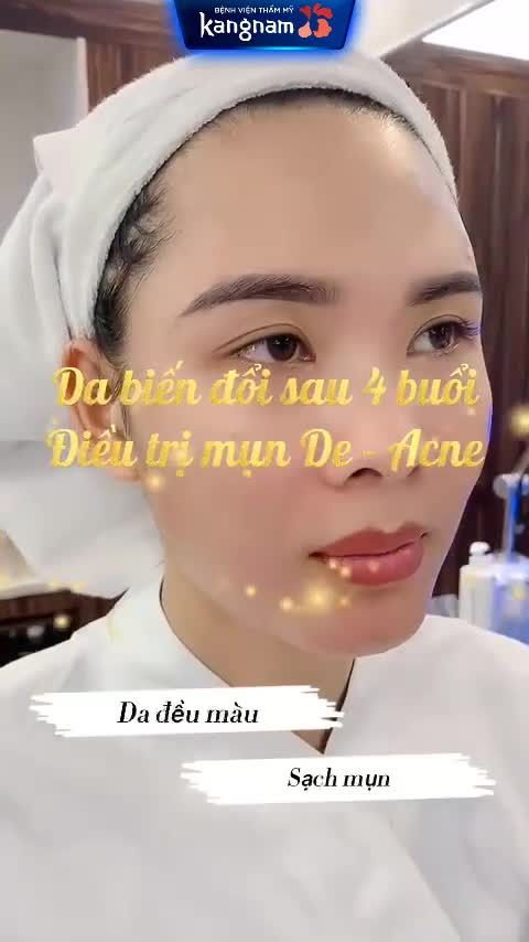 "Sợ soi gương vì da quá nhiều mụn, dùng đủ mọi cách mà da vẫn chưa được cải thiện"