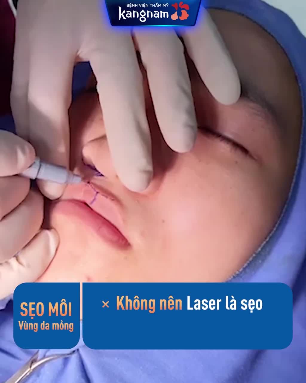 Sửa SẸO MÔI? Nên LASER là sẹo hay PHẪU THUẬT?
