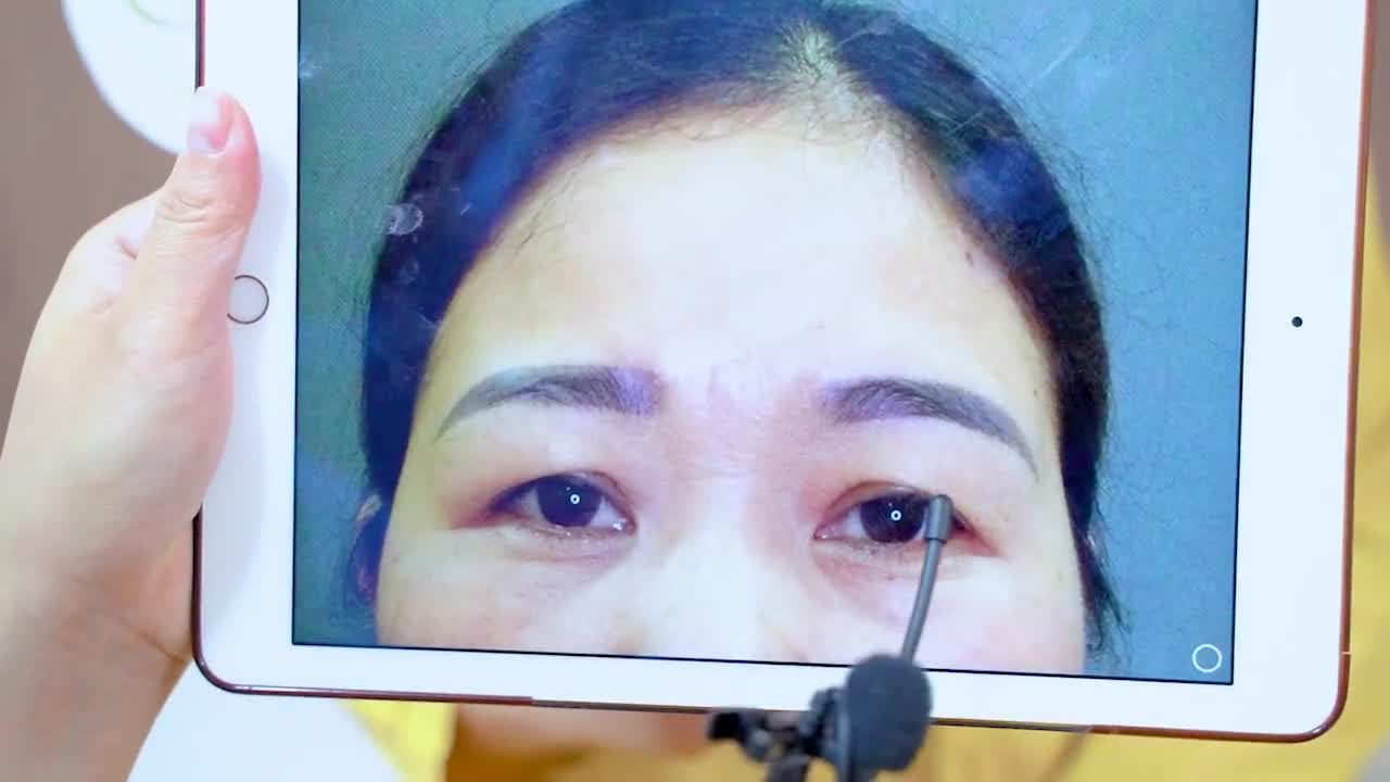Sụp mí già nua còn gây nặng mắt, che khuất tầm nhìn Phải làm sao?