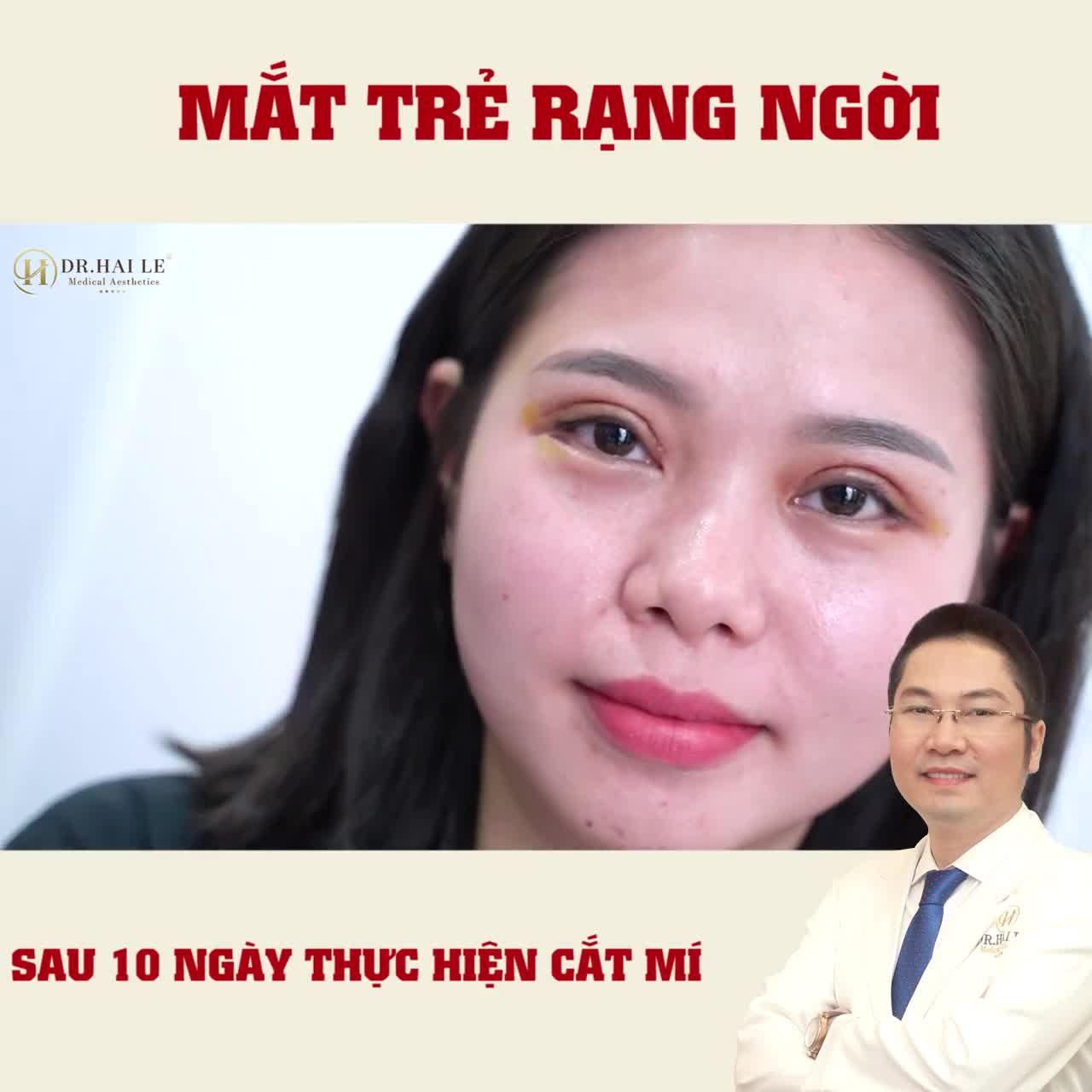 Tại sao khách hàng tin tưởng lựa chọn Cắt mí tại Dr.Hải Lê?