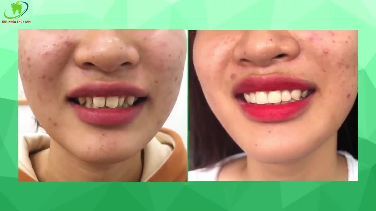 THAY ĐỔI NỤ CƯỜI, TỰ TIN GIAO TIẾP