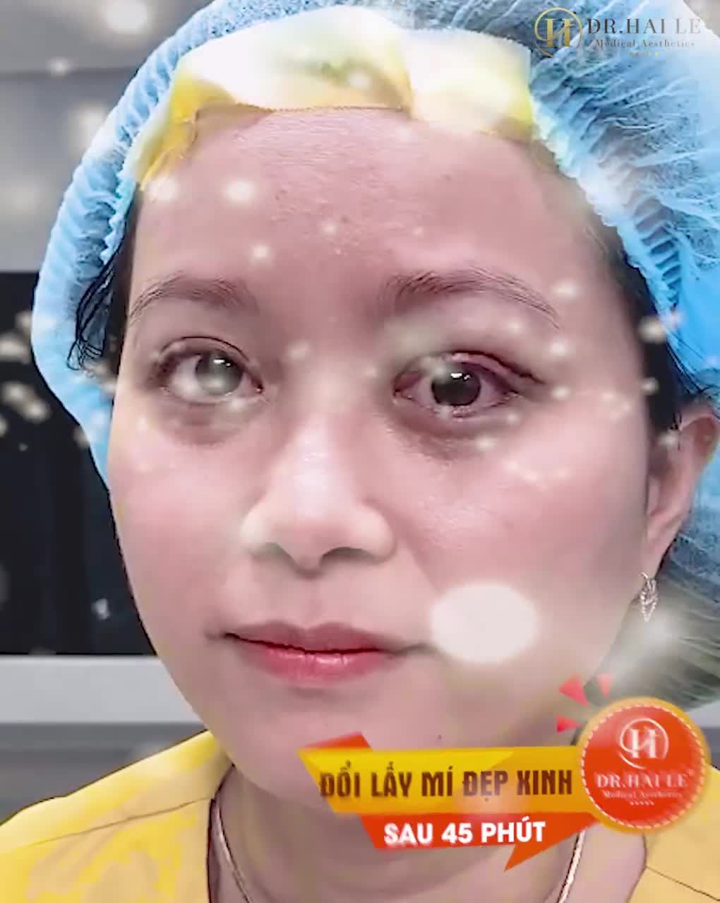 Theo dõi video để có kinh nghiệm PTTM mắt cũng như chọn địa chỉ thẩm mỹ uy tín để có thể giúp bạn thân không chỉ đẹp mà còn an toàn về sức khỏe của đôi mắt nữa bạn nhé!