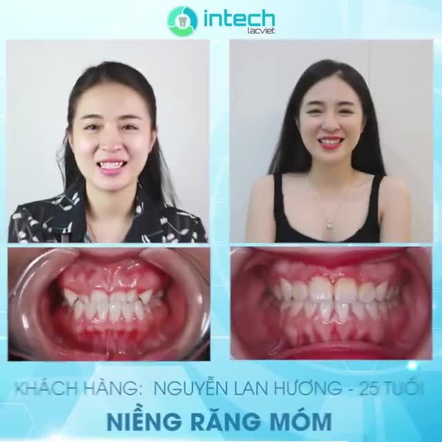 TỔNG HỢP NHỮNG MÀN LỘT XÁC NGOẠI MỤC SAU NIỀNG RĂNG TẠI HỆ THỐNG NHA KHOA LẠC VIỆT INTECH