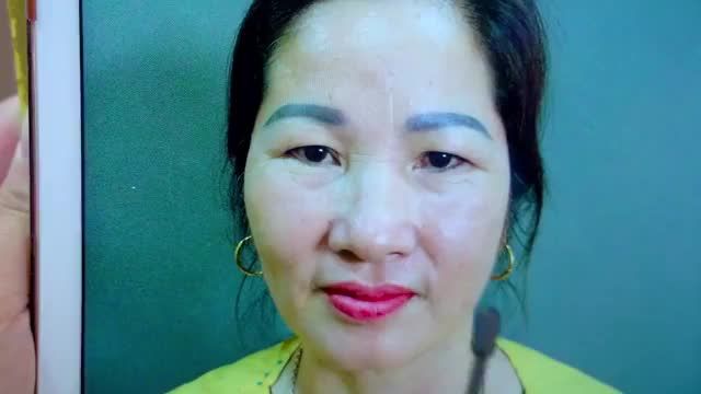 Trẻ hóa đôi mắt sụp mí già nua giúp vị khách hàng trẻ sang rạng rỡ chỉ sau 45 phút thực hiện tiểu phẫu Nâng cung mày