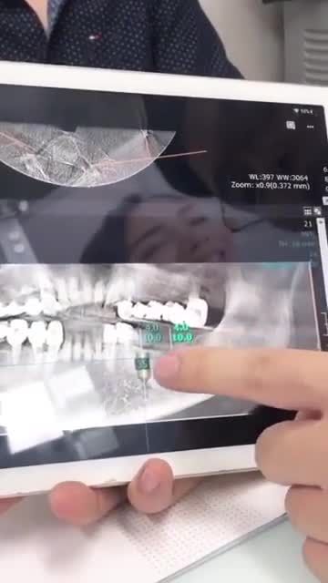 TRỒNG RĂNG GÃY RỤNG, LUNG LAY DO SÂU VIÊM, CẦU RĂNG CŨ