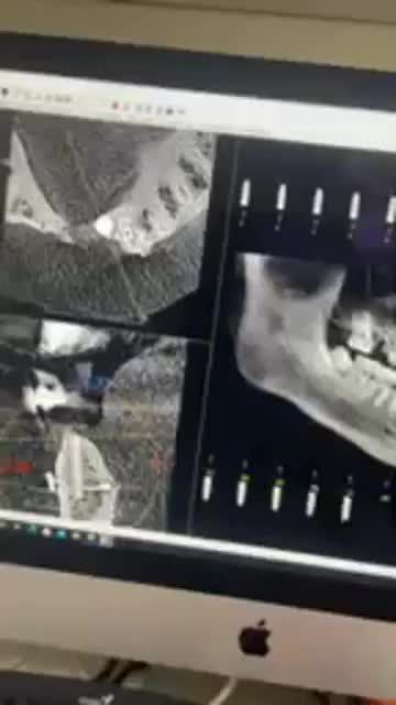 Trồng răng Implant 5S chuẩn Đức - Khôi phục mọi trường hợp mất răng