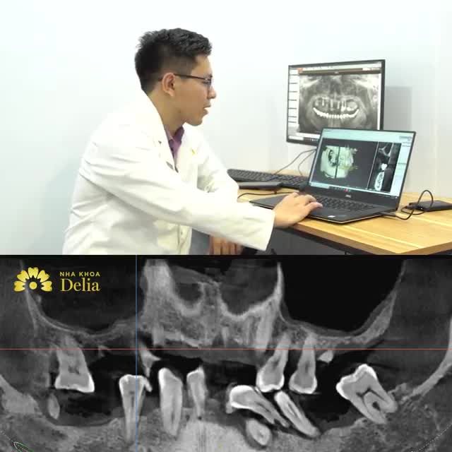TRỒNG RĂNG IMPLANT - khách hàng mất đến 18 răng trên cung hàm