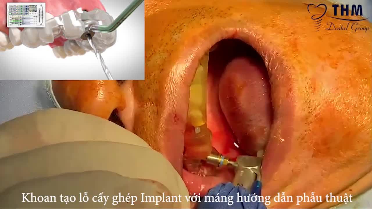 TRỒNG RĂNG IMPLANT - PHỤC HỒI RĂNG MẤT - TẬN HƯỞNG CUỘC SỐNG
