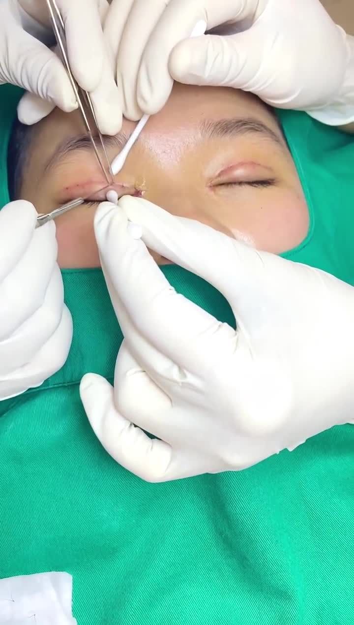 Trực tiếp cắt chỉ cho khách cắt mí- mở góc trong sau 6 ngày phẫu thuật. Hoàn toàn không sưng, không bầm tím. Mắt vào nếp mí to tròn , đều đẹp. Góc trong mở rộng tối đa hết nếp dẻ quạt và góc mắt thoáng hơn.