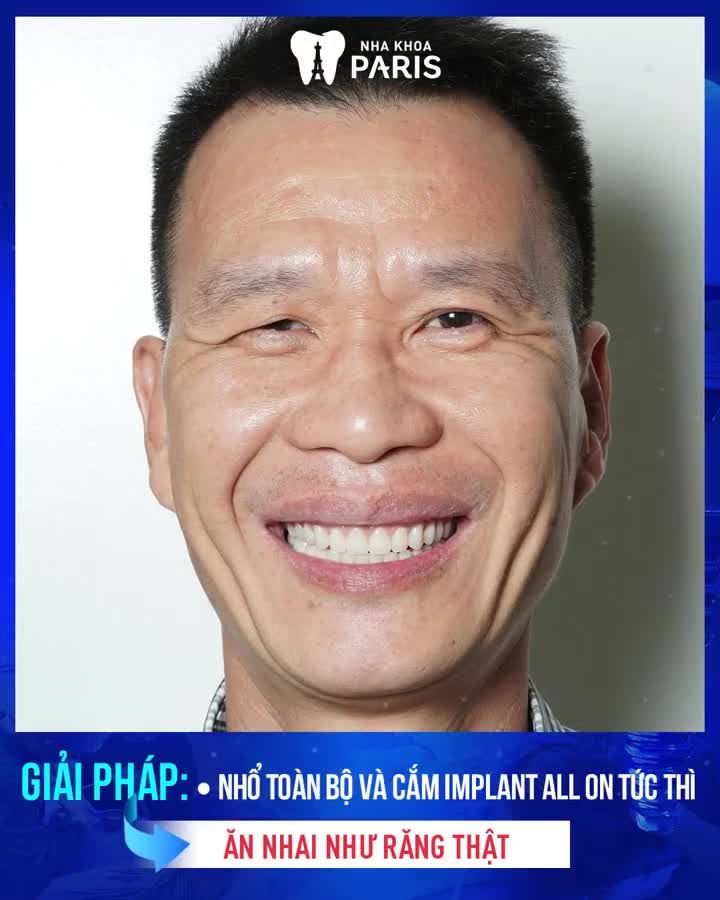 TS.BS Laurent Trâm - Chuyên gia phục hình Implant hàng đầu Hà Nội