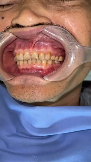TS.BS Trịnh Đức Mậu thực hiện phục hình 32 răng sứ toàn sứ cho khách hàng tại cơ sở 84A Hai Bà Trưng.