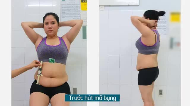 Từ vòng eo 103cm, chảy xệ 8cm sau sinh giờ đây đã thay đổi hoàn toàn sau ca hút mỡ tạo dáng thẩm mỹ Chị Thảo (31 tuổi) chia sẻ: