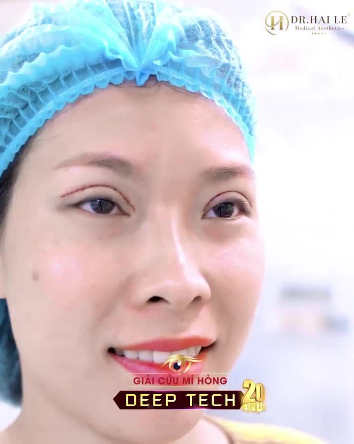 Từng cắt mí hỏng rồi sửa lại tới 4 lần do lựa chọn cơ sở không uy tín, thực hiện sai kỹ thuật.