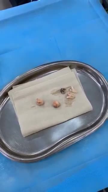 XỬ ĐẸP 03 CHÚ RĂNG KHÔN CHỈ TRONG 1 LẦN PHẪU THUẬT