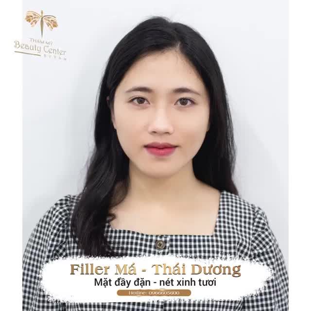XUÂN TƯƠI PHƠI PHỚI với Filler thái dương- hóp má