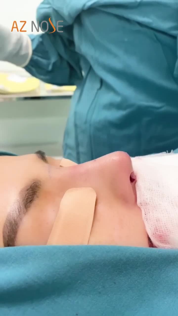 Xuất sắc quá! Mũi cụp biến thành dáng mũi cao tây sang chảnh: