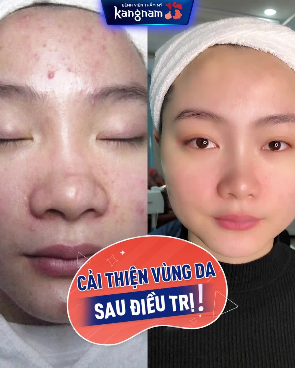 Bạn bị mụn lâu năm, mụn nội tiết điều trị không hiệu quả