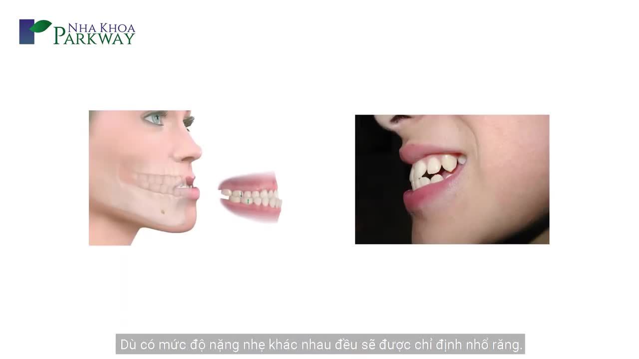 BẠN BIẾT GÌ VỀ NHỔ RĂNG KHI NIỀNG