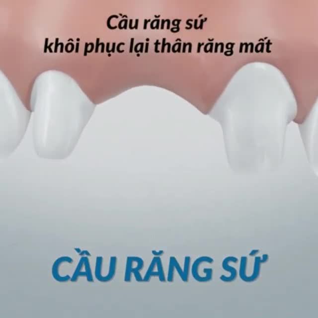 BẠN CHẮC CHẮN SẼ SẼ CHỌN CẤY GHÉP IMPLANT NẾU BIẾT NHỮNG ĐIỀU NÀY!