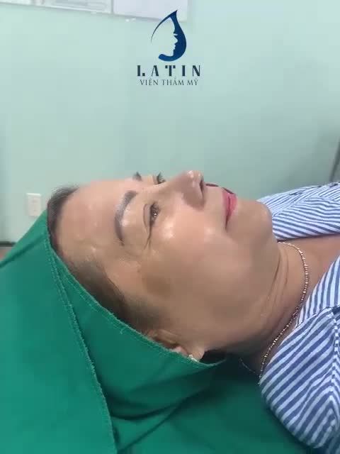 Ca mũi bán cấu trúc thu gọn đầu mũi dáng nhẹ nhàng tự nhiên đã có kết quả rồi đây ạ.