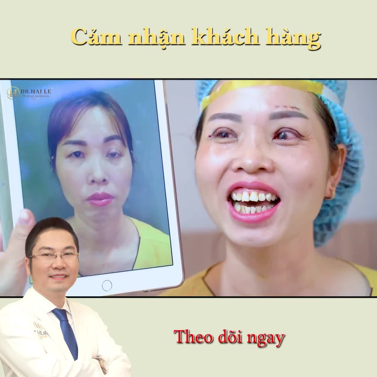 Cam thường 100%, cận cảnh từng milimet kết quả sửa mí tại Dr.Hải Lê. Đôi mắt mới ấy có xứng đáng nhận được like và tym không ạ