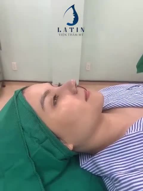 Cận cảnh ca mũi cấu trúc sửa lại vừa hoàn thành tại TMV Latin
