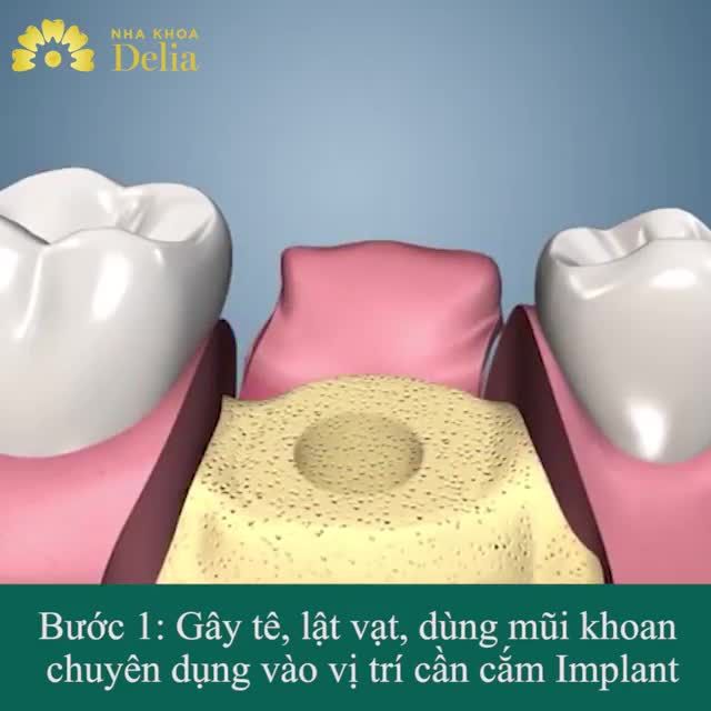 CẬN CẢNH QUY TRÌNH CẮM IMPLANT PHỤC HÌNH RĂNG MẤT