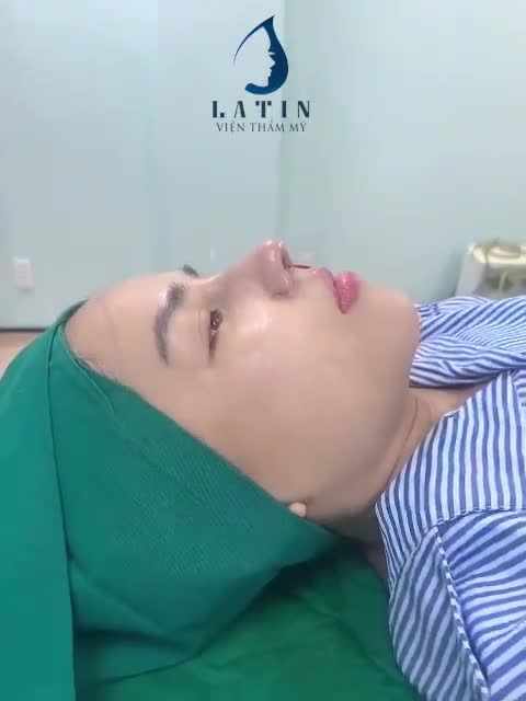 Case mũi cấu trúc Latin sóng Surgiform vừa hoàn thành ngay trên bàn PT.