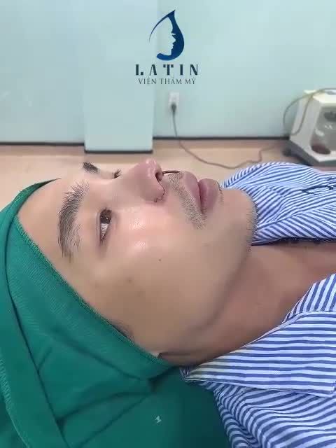 Case mũi cấu trúc sửa lại + chỉnh chân cánh mũi cho bạn nam tới từ Cần Thơ.