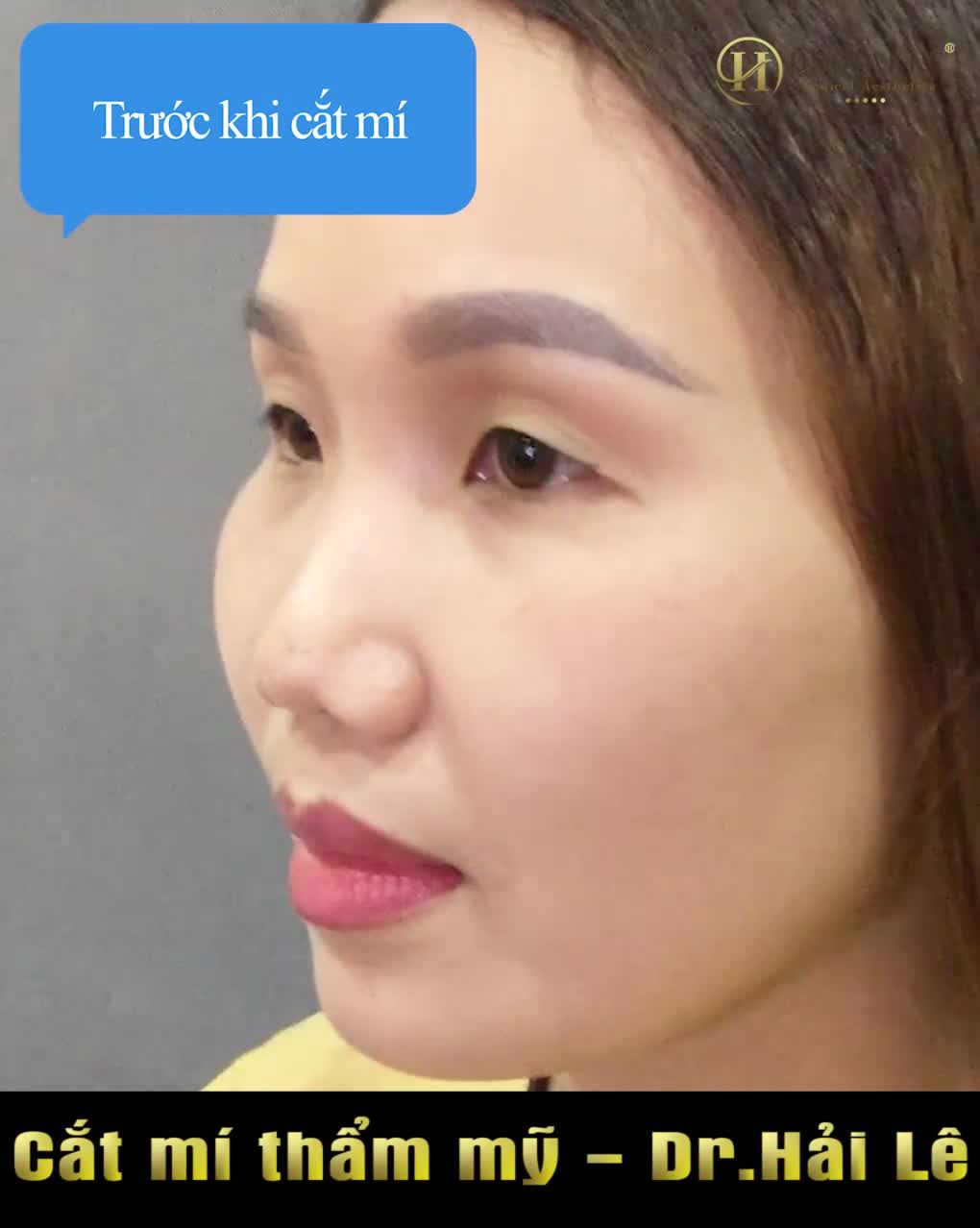 Cắt mí sau 1 tuần, ai thấy cũng khen đẹp, thực sự trông khác lắm.
