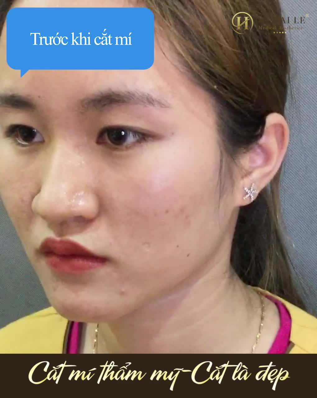 Cắt mí xong cứ ngỡ 2 người khác nhau luôn í. "Xóa sổ" mắt 1 mí, mí lót trong tích tắc là có thật.