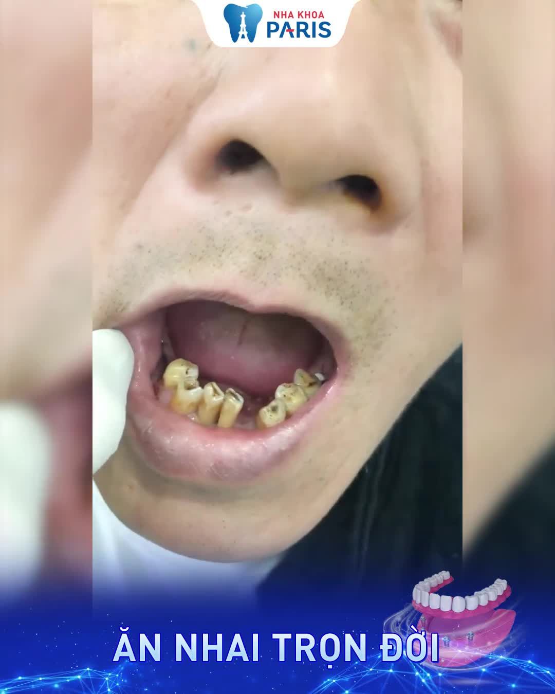 Cấy 7 trụ Implant cảm giác thế nào