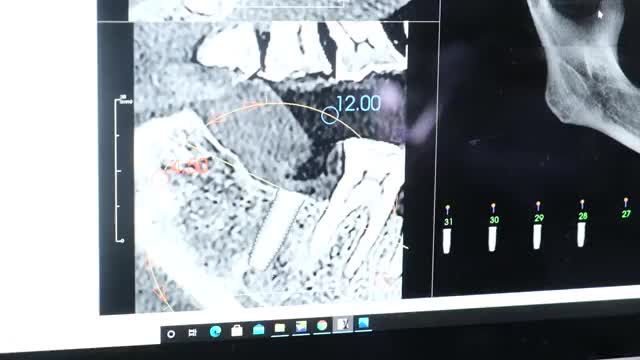 Cấy ghép implant cho khách hàng là Chú Trần Hữu Huân tại cơ sở 84A Hai Bà Trưng