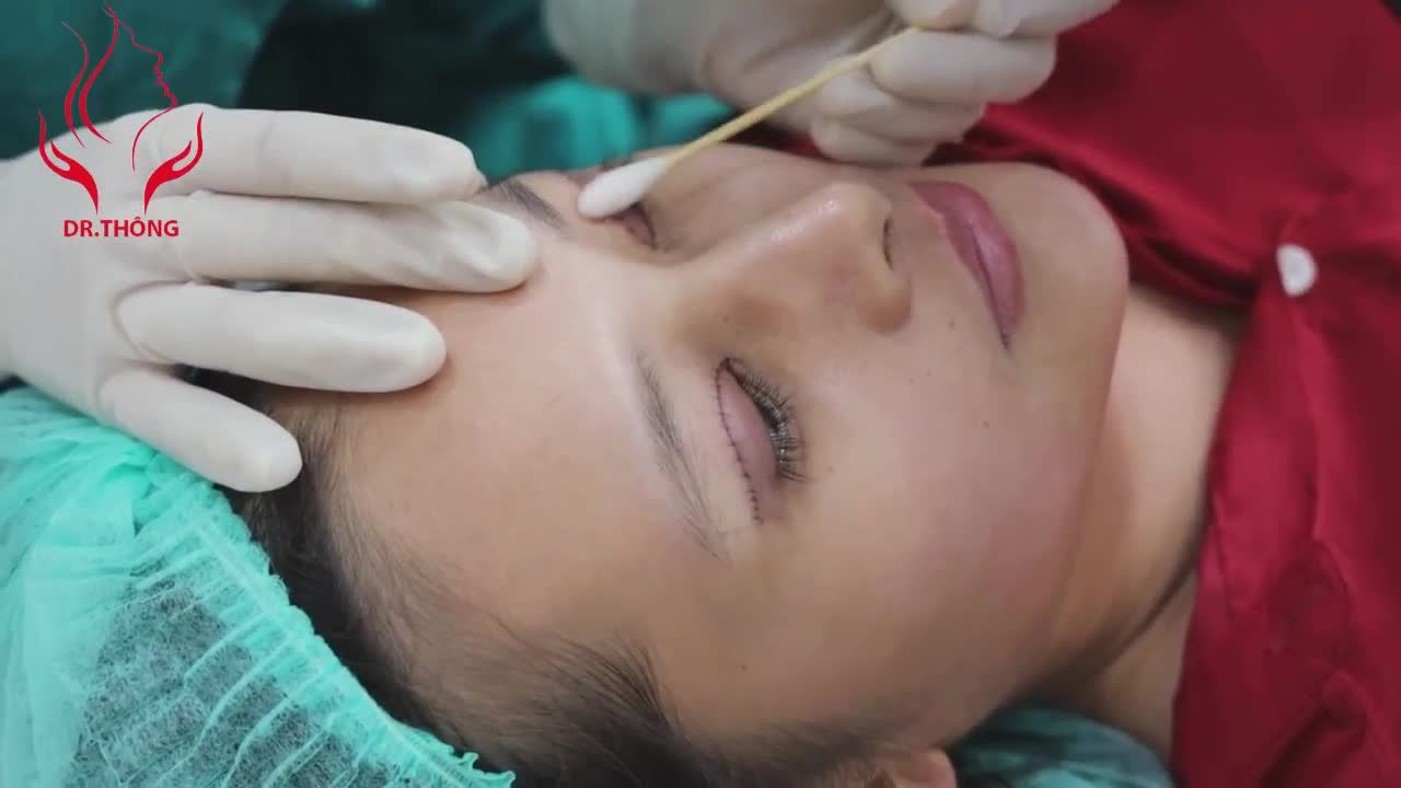 Chị em nào còn lo sợ cắt mí mắt xong sẽ sưng bầm, đỏ tía, hạn chế tầm nhìn...vùng mắt nên khó mà đi đâu chỉ ở nhà, thì xem ngay clip này nhé!