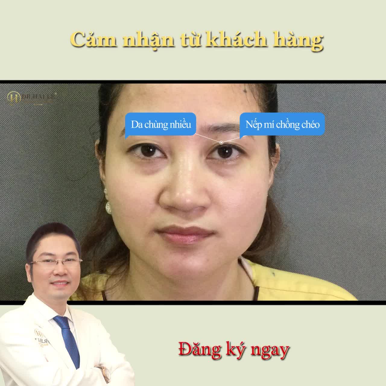 "Chị tâm lý vững lắm làm chị không có thấy đau gì... quan điểm của chị làm đẹp thẩm mỹ bây giờ như bữa cơm hằng ngày nên bình thường lắm, chị không ngại gì đâu, sụp mí chị đi làm trông cho trẻ..."