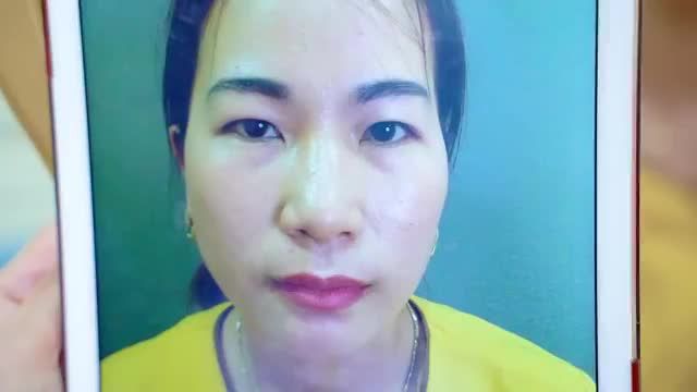 Chiêm ngưỡng kết quả Cắt mí tươi trẻ rạng ngời chỉ sau 45 phút thực hiện tiểu phẫu Mời cả nhà cùng đón xem