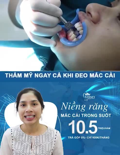 CHỈNH NHA THẨM MĨ CÙNG MẮC CÀI PHA LÊ