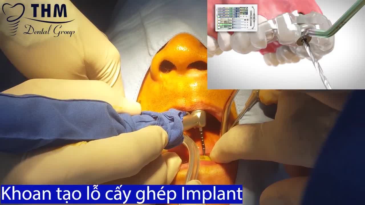 Chú V. Xuyên (57t-TP.HCM) - cấy ghép 4 trụ Implant Châu Âu  Bác sĩ thực hiện: BS. Nguyễn Xuân Tâm
