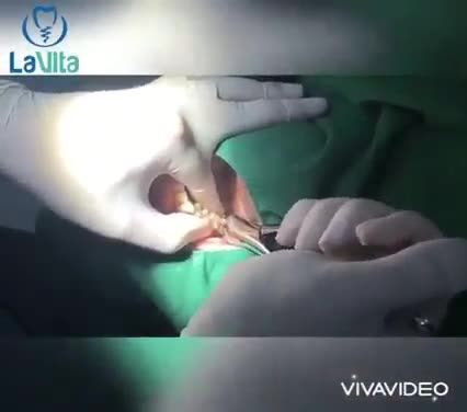 CHƯA KỊP ĐAU ĐÃ NHỔ XONG RĂNG KHÔN LÀ CÂU CHUYỆN HOÀN TOÀN CÓ THẬT